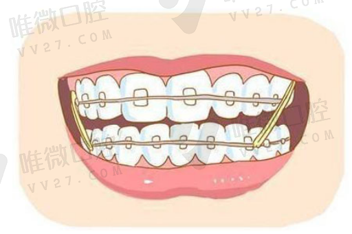 假牙和种植牙的区别怎么种,镶牙是种牙吗(图1)